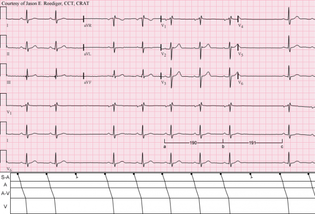 Sick Sinus Syndrom Ekg Bild www.ecgguru.com